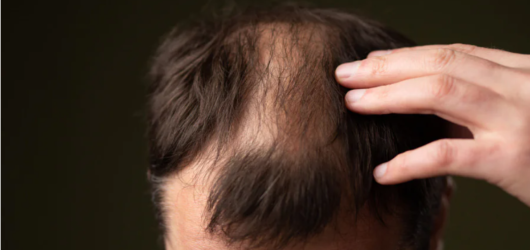 A Verdade Sobre a Queda de Cabelo: Dicas que Funcionam de Verdade