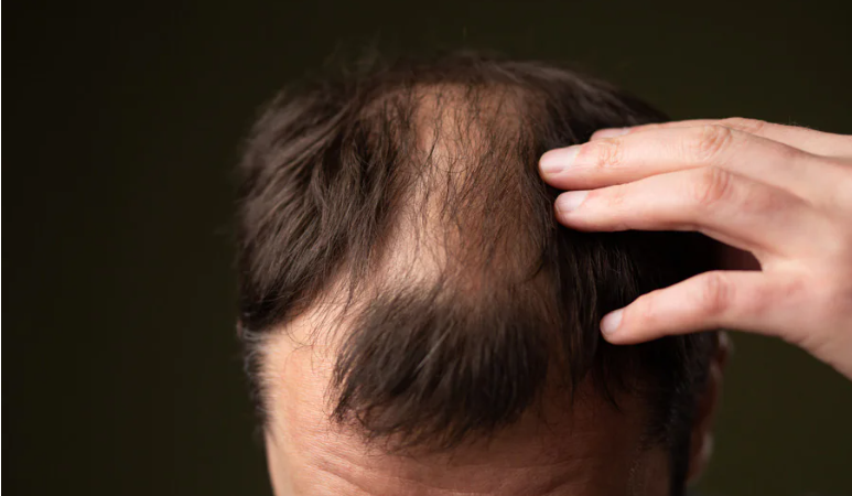 Como parar de perder cabelo: guia masculino